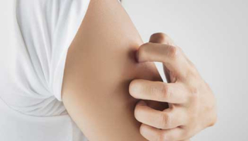 Piqûre de puce : comment la reconnaître et comment la traiter ?